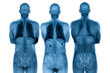 3 human spine, radiographic effect on a transparent background