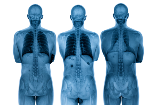 3 human spine, radiographic effect on a transparent background