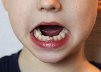 Smile of a child with milk teeth. The first baby tooth that fell out. Pediatric Dentistry