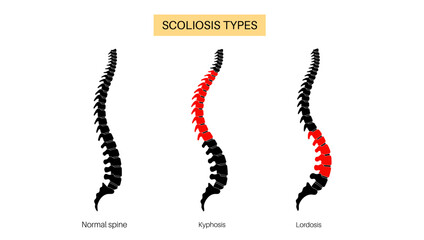 Scoliosis medical poster