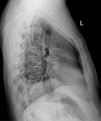 Left Lateral Chest X-Ray Showing Thoracic Cavity and Spine