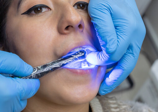 A close-up view inside a patient's mouth during a dental procedure, where a dentist is using a dental curing light - Powered by Adobe