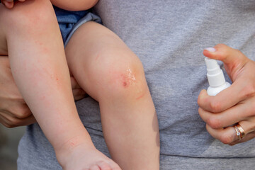 Scratches on a child's leg. small child.
