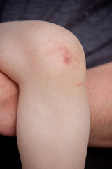 Fototapeta premium Scratches on a child's leg. small child.