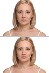Woman showing face before and after collagen consumption on white background. Collage of photos...