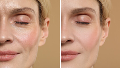 Woman showing face before and after collagen consumption on beige background, closeup. Collage of...