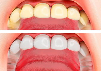 Patient before and after professional teeth whitening treatment. 3D illustration