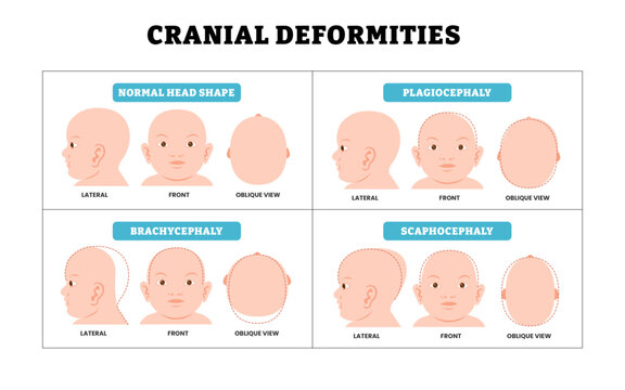Different types of cranial deformities baby infant child newborn defect birth, educational medical poster design healthcare, plagiocephaly, brachycephaly, scaphocephaly with side, front, lateral view.