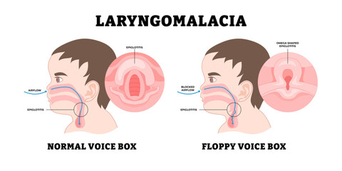 Fototapeta premium Baby Laryngomalacia, educational medical poster design healthcare, labeled noisy breathing in babies, soften or floppy abnormality larynx (voice box) tissue vocal cords, stridor, fall back airways.