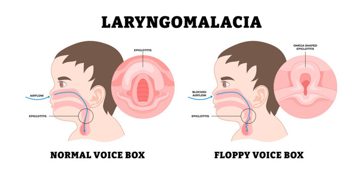 Baby Laryngomalacia, educational medical poster design healthcare, labeled noisy breathing in babies, soften or floppy abnormality larynx (voice box) tissue vocal cords, stridor, fall back airways.