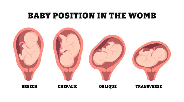 Different types of baby position in the womb during pregnancy, educational medical poster design healthcare, labeled Cephalic, Breech, transverse, Oblique lies, Fetus with umbilical cord and placenta.