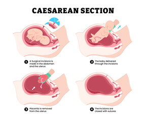 Steps of caesarean section c-section surgery steps, educational medical poster design healthcare, labeled surgical incision, baby delivery, remove placenta in uterus, closed incision suture.