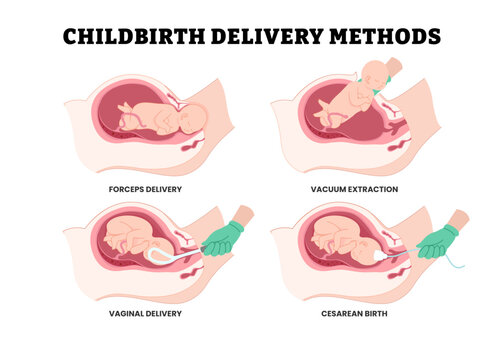 Different types of childbirth delivery methods steps procedure with doctor, educational medical poster design healthcare, labeled forceps delivery, vacuum extraction, vaginal delivery, cesarean birth.