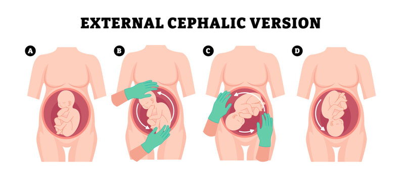Steps of external cephalic version steps methods procedure with doctor hans, educational medical poster design healthcare, labeled manually turn baby from breech to head-down cephalic position birth.