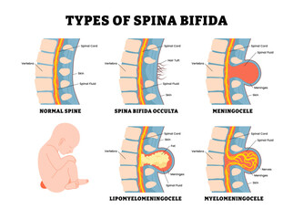 Different types of spina bifida pregnancy, educational medical poster design healthcare, normal spine, occulta, meningocele, lipomyelomeningocele, myelomeningocele. Covered spinal cord, birth defect.