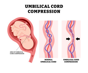 Obraz premium Baby Umbilical Cord Compression, educational medical poster design healthcare, labeled flattened or squeezed umbilical cord, restrict blood flow and oxygen to the fetus.