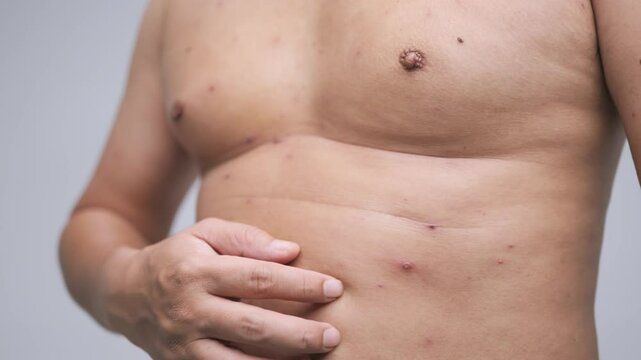 Male torso with visible chickenpox marks, rashes, and signs of skin allergies.