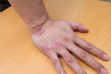 Hand showing eczema rash on skin surface