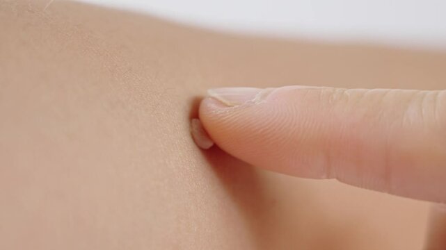 Skin tag or acrochordon or soft fibrom dermatology problem on skin concept.