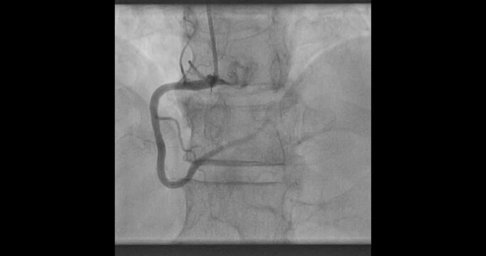 Coronary Angiogram &ndash; High-Resolution Medical Imaging of Heart Blood Vessels
