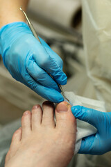 Podiatrist cleans nail groove using curved metal tool and tissue. Chiropody and podology concept,...