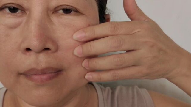 Portrait the fingers holding the flabbiness adipose sagging skin beside the eyelid, ptosis and swelling under the eyes, dark spots and blemish, freckles and scar on the face of the woman.