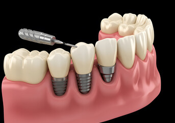 Dental Implant Surgery Procedure: A 3D Model Showing the Insertion of Dental Implants and Crowns