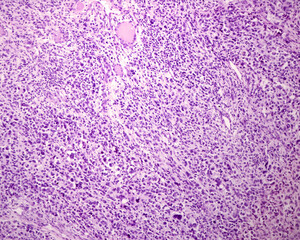 Human skin. Pleomorphic sarcoma