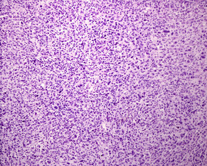 Human skin. Pleomorphic sarcoma