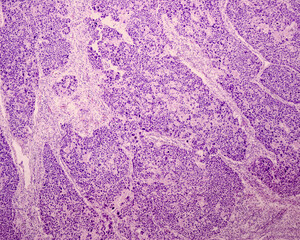 Squamous cell carcinoma