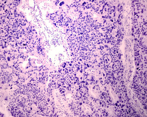 Squamous cell carcinoma