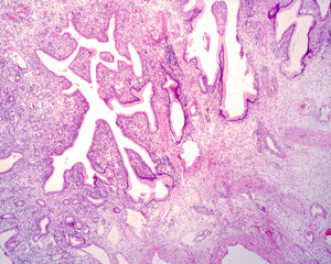 Human endocervical polyp