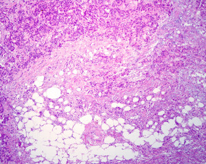 Undifferentiated adenocarcinoma. Metastatic nodule