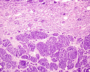 Human kidney. Wilms tumour