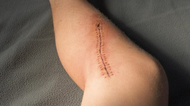 Fresh surgical scar with stitches on a bent knee. Medical recovery concept