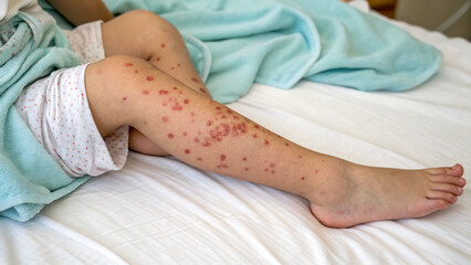 Pediatric Shingles Rash – Scattered Vesicles and Inflammation on Child’s Leg