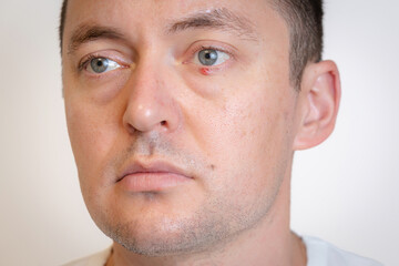 Man's eyes with pus redness like chalazion caused by blocked sebaceous glad on lower eyelid....
