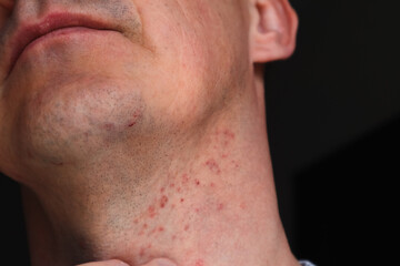 Fototapeta premium Skin irritation after shaving. Skin irritation on male neck after shaving. Close-up photo.