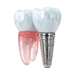 A dental implant stands next to a semi transparent molar, showcasing modern dentistry and restoration on a clean, white background, emphasizing dental health.
