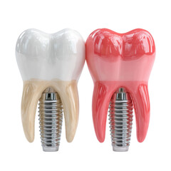 Two dental implants, one natural and one with gum inflammation, are shown on a white background, highlighting dental health and potential complications.
