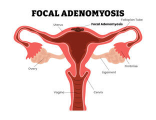 Adenomyosis, focal, adenomyoma, diffuse, female reproductive system, educational medical poster design healthcare scheme, internal organs cervix, fertility problem infertility. Internal endometriosis.