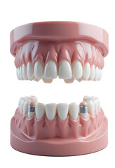 Obraz premium dental implant with teeth