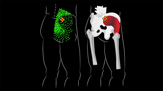 Trigger points and referred pain in the gluteus medius muscle