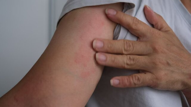 Hands are scratching an allergic arm suffering severe urticaria or hives or kaligata.