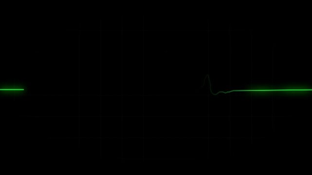 EKG flatline. Cardiogram indicating cardiac arrest heart attached. Green glow over black background for medical video.