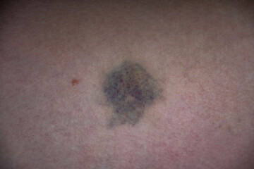 Fototapeta premium Close-up of a bruise on human skin, showing discoloration and healing process. This image illustrates the effects of impact or injury.