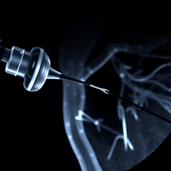 Coronary Imaging Catheter. Dual Lumen Catheter. Coronary angiography showing Micro Catheter guidewire.