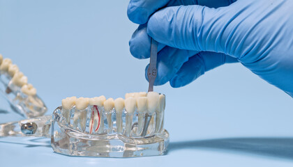Close-up of a gloved hand using a dental shade guide to match the color of a tooth implant on a...