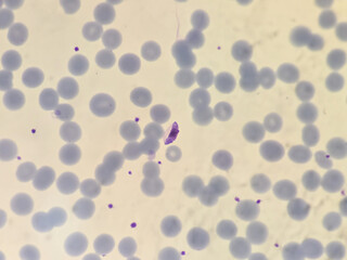 This is plasmodium falciparum gametocyte form stage by microscopic 100x lens causing malaria. by thin film method.