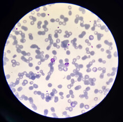 This is plasmodium vivax amoeboid form stage by microscopic 100x lens causing malaria. by giemsa stain method.